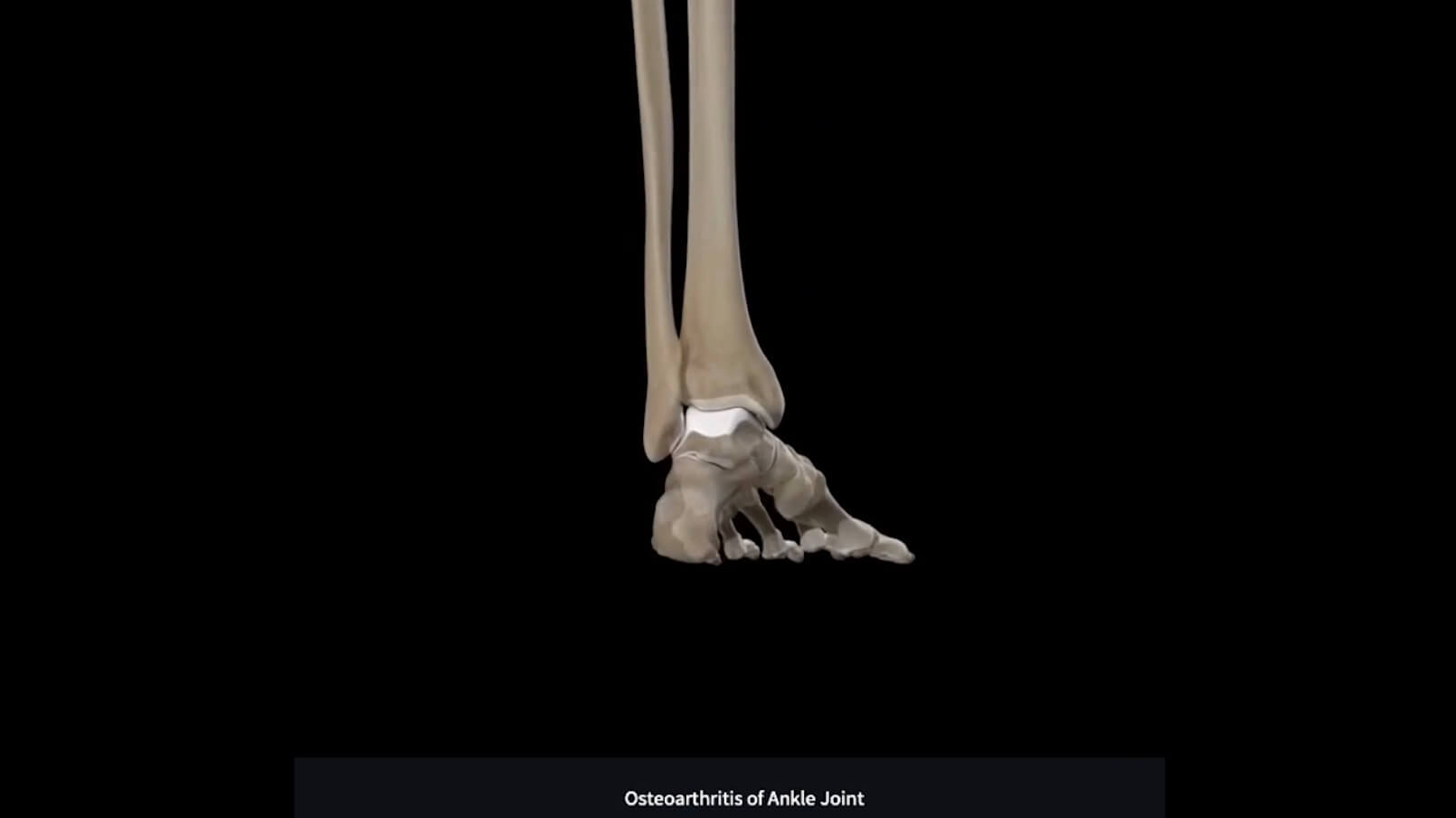 Ankle Arthritis DIAGNOSIS