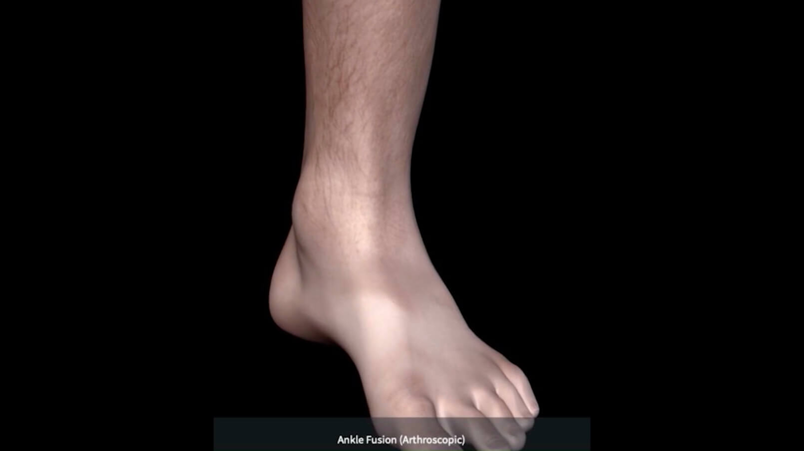 Ankle Arthritis TREATMENT
