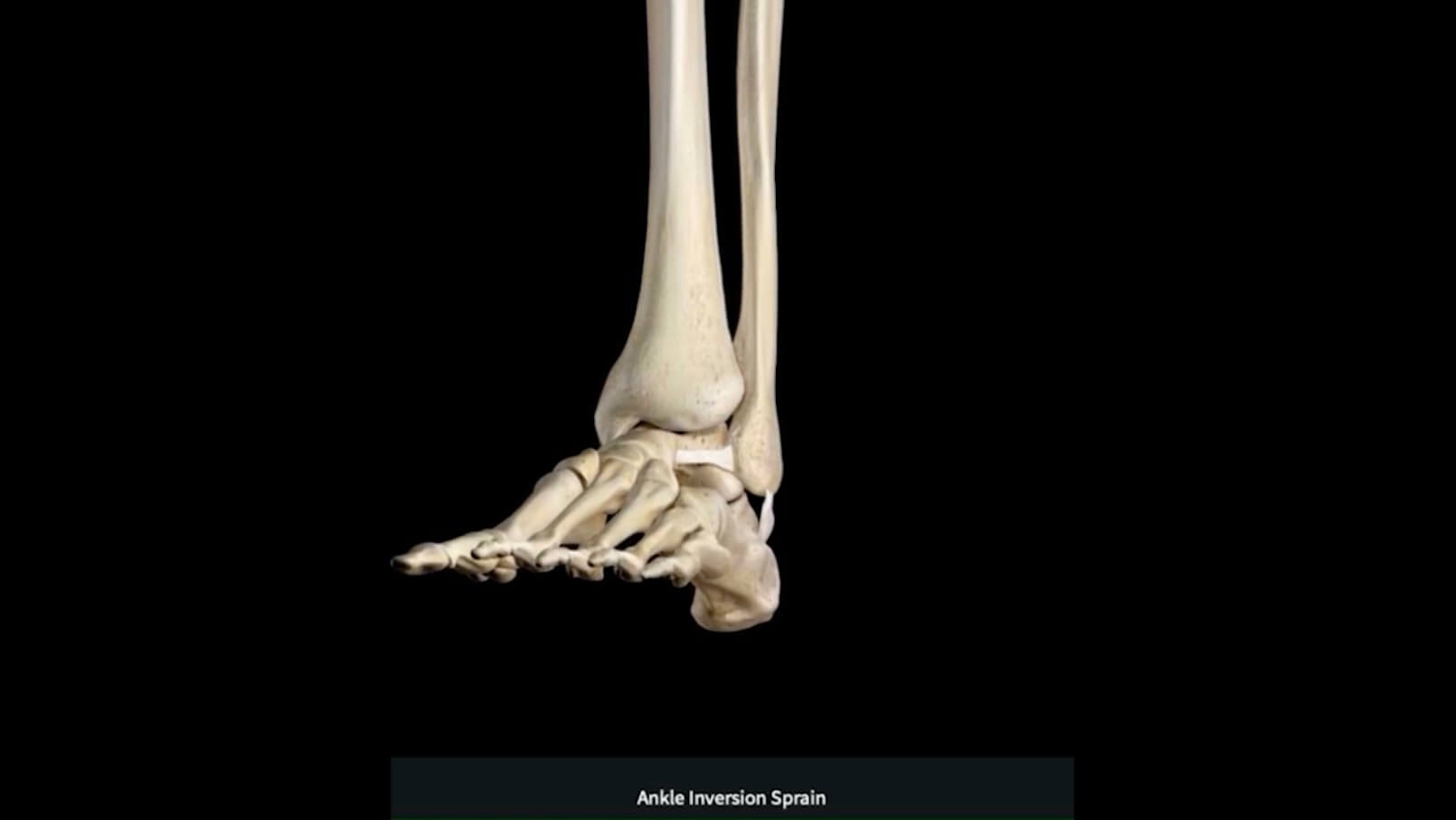 Ankle Inversion Sprain DIAGNOSIS