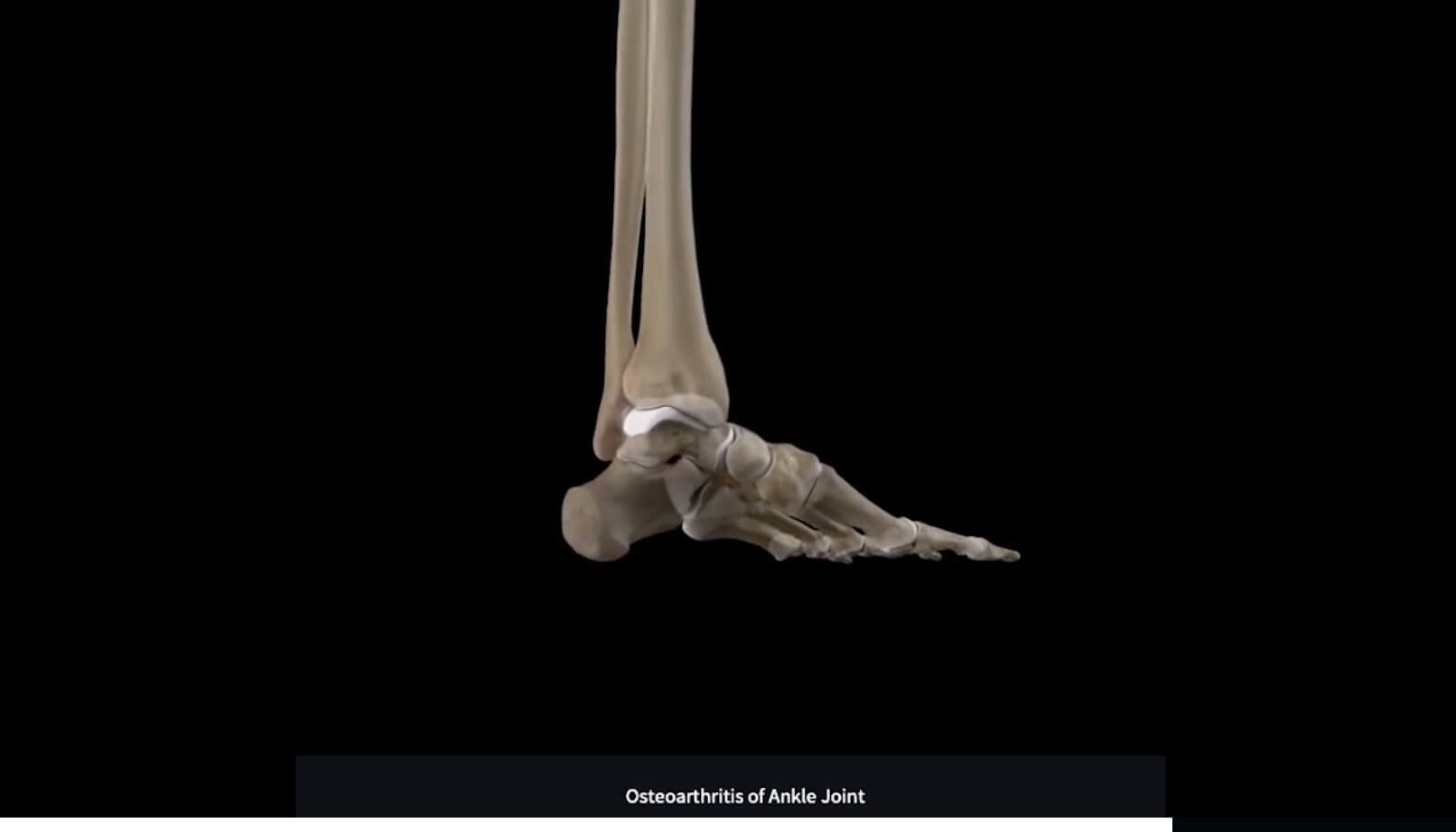 Ankle Osteoarthritis DIAGNOSIS