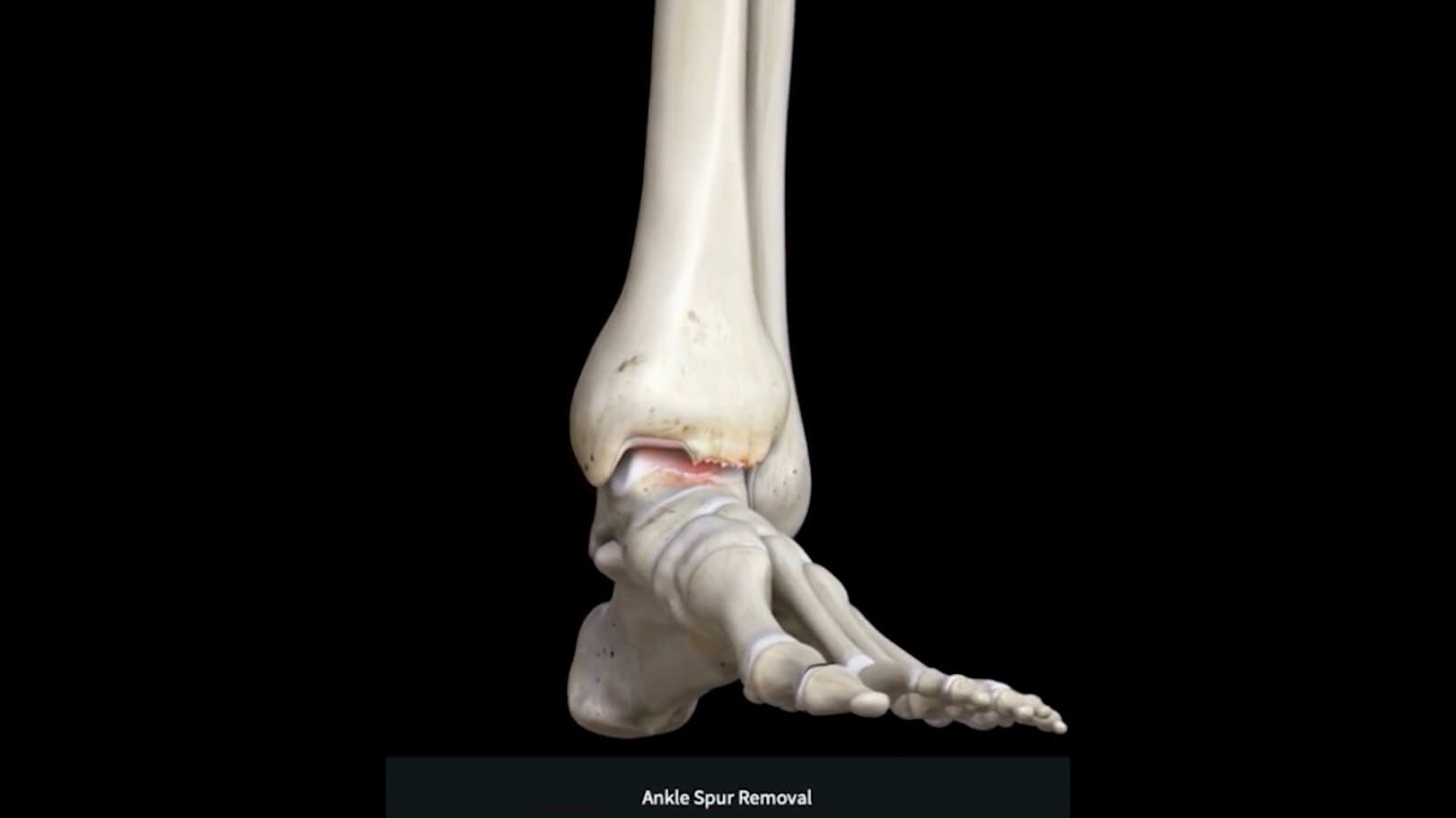 Ankle Spur Treatment