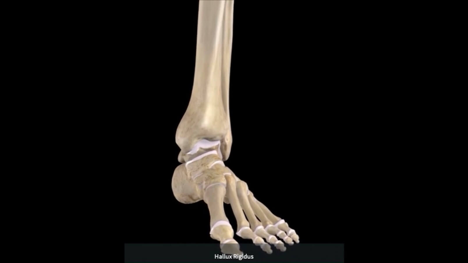 Big Toe Arthritis DIAGNOSIS