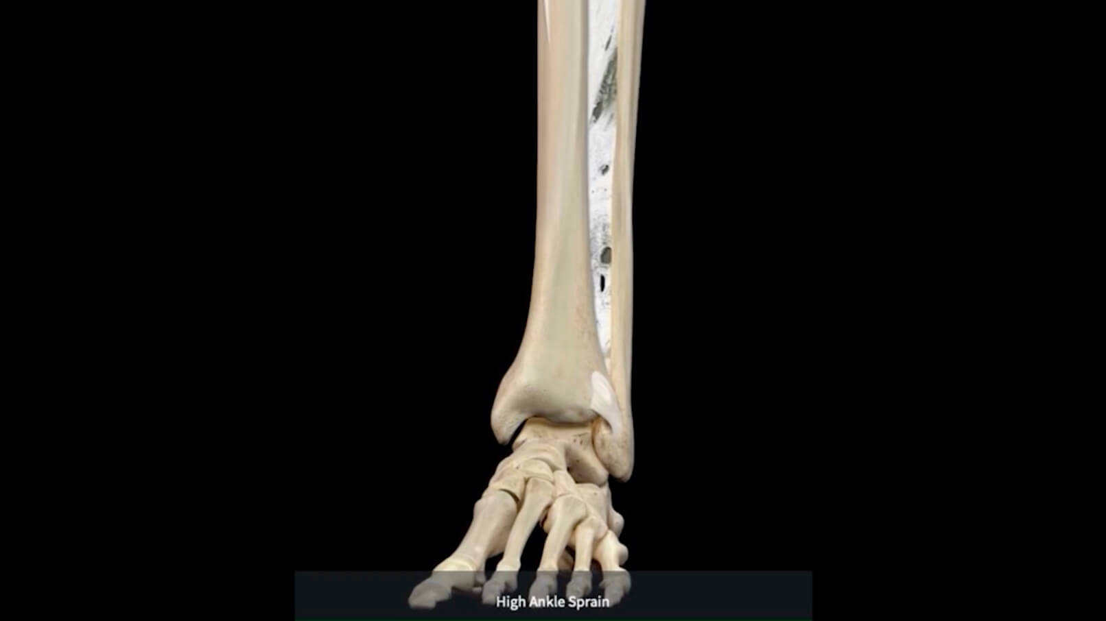 High Ankle Sprain DIAGNOSIS
