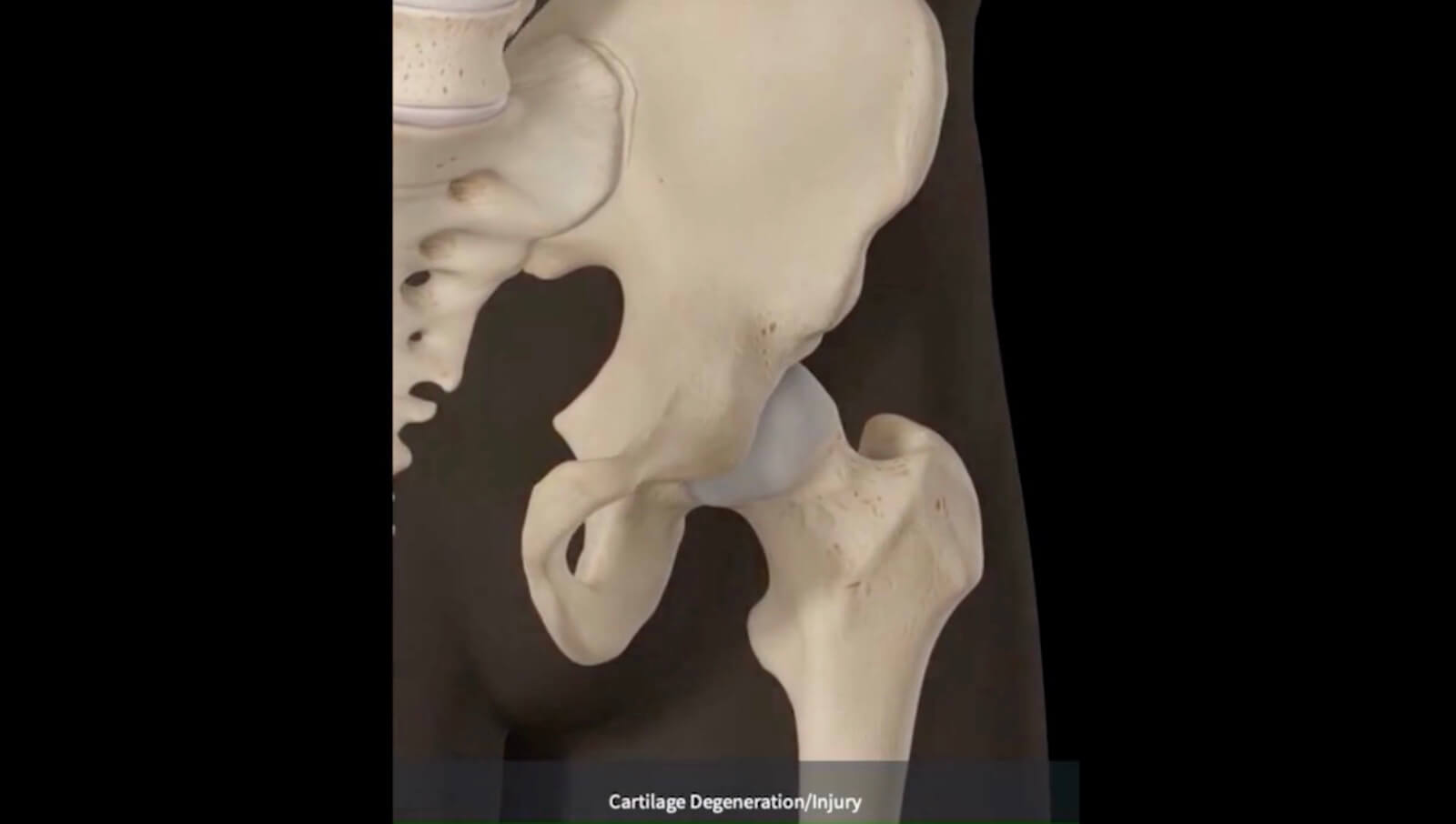 Hip Arthritis and Hip Replacement DIAGNOSIS