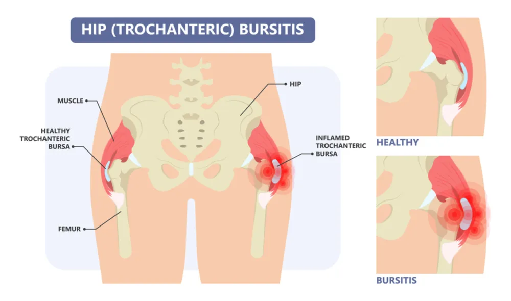 Hip Bursitis 1
