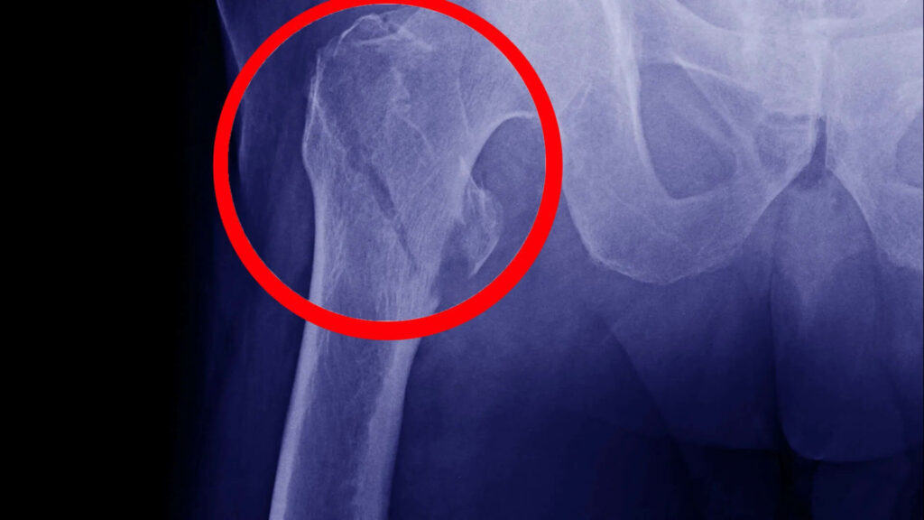 Intertrochanteric Fracture