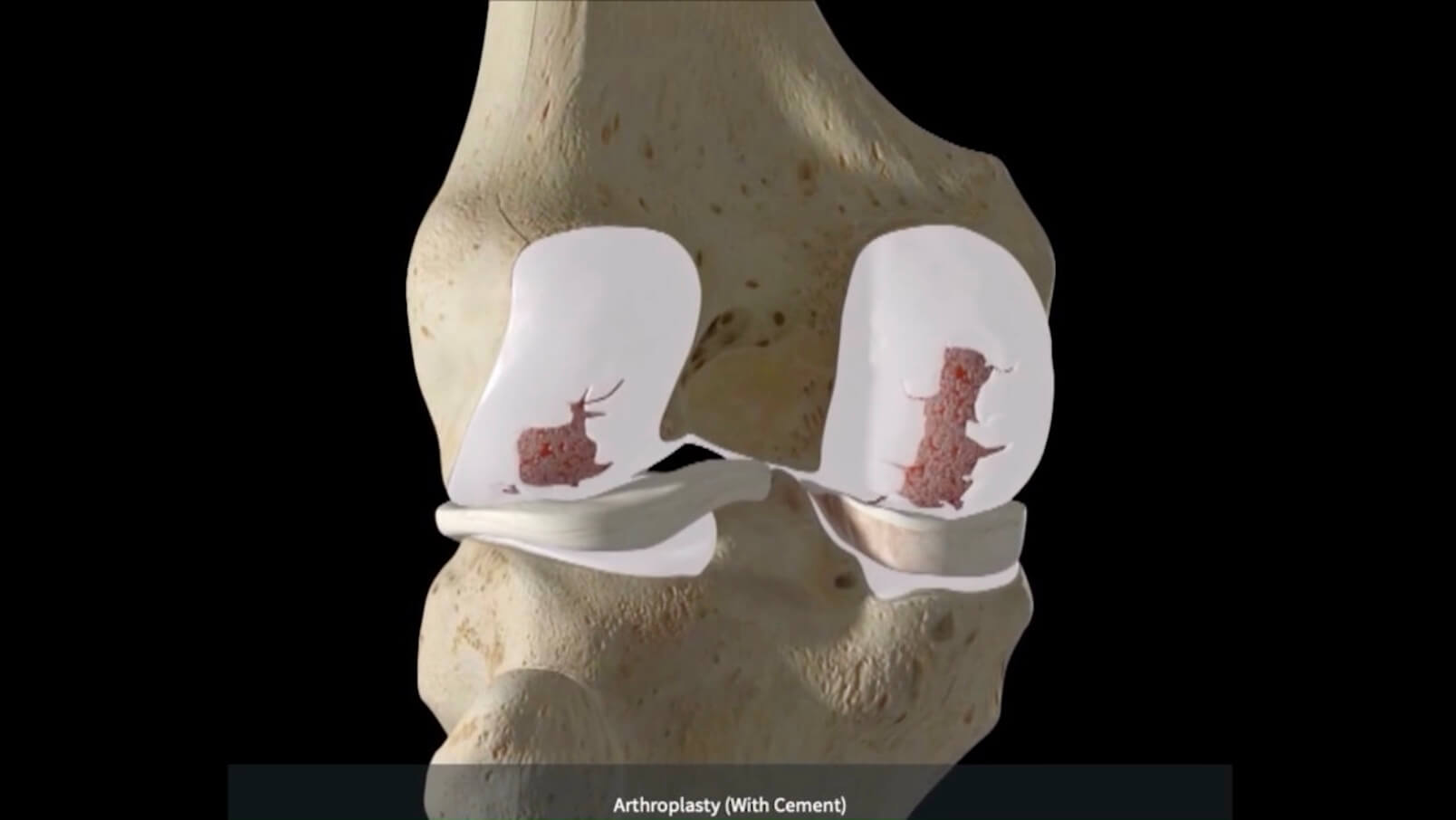 Knee Arthritis and Knee Replacement TREATMENT