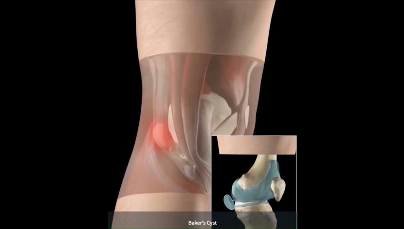 Knee Bakers Cyst DIAGNOSIS