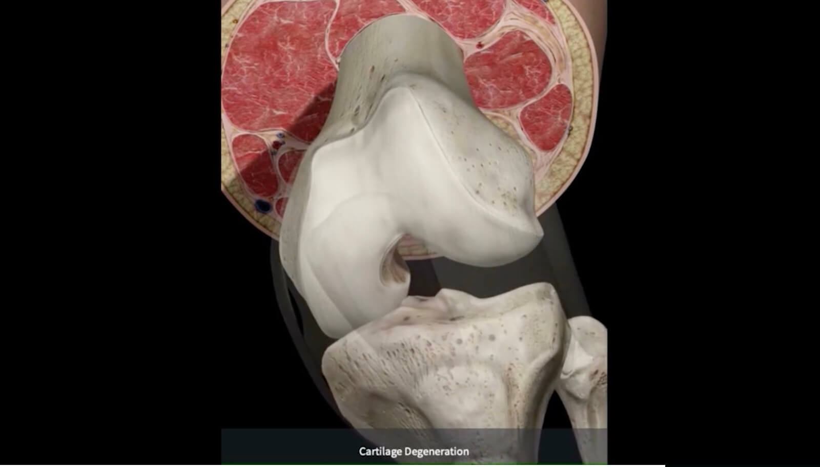 Knee Cartilage Abrasion DIAGNOSIS