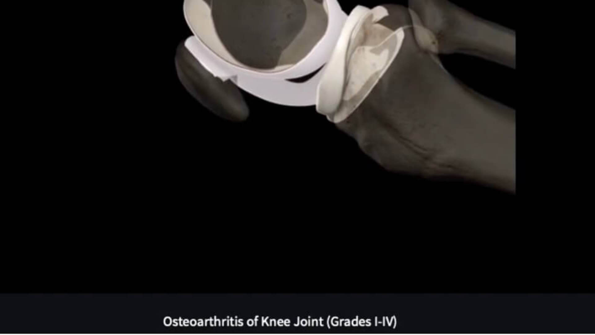 Knee DJD Degenerative Joint Disease DIAGNOSIS RESIZED