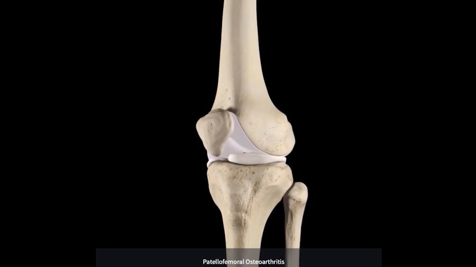 Knee Osteoarthritis DIAGNOSIS