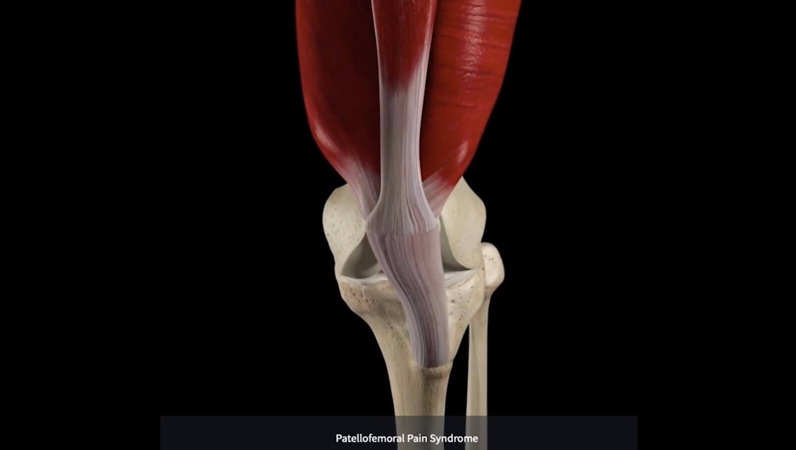 Knee Patellofemoral Pain Syndrome DIAGNOSIS