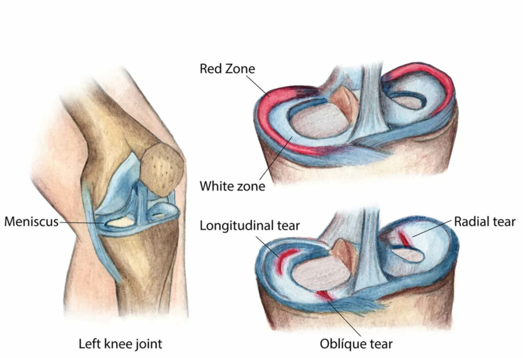 Meniscus Radial Tear