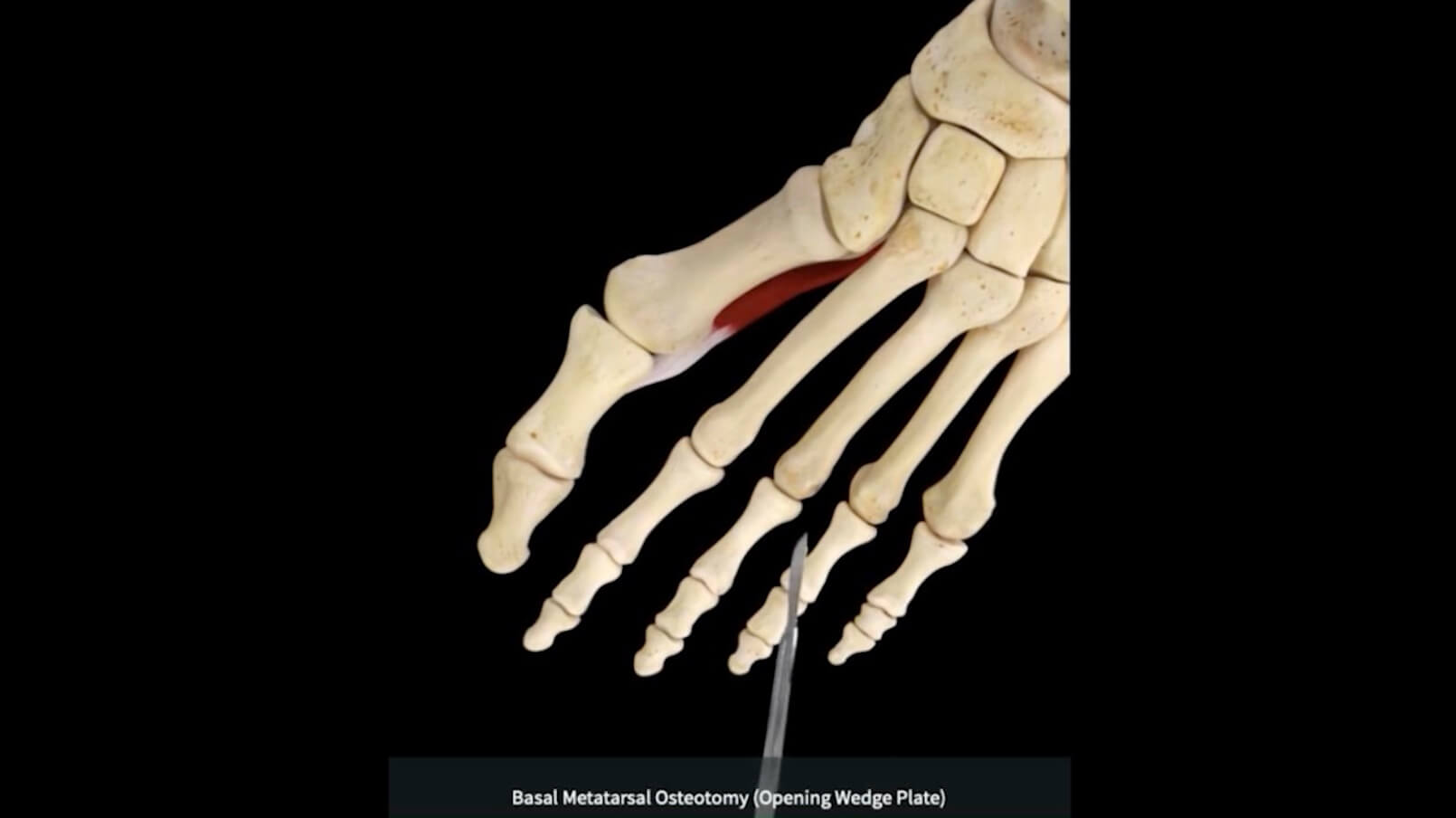 Moderate to Severe Bunion TREATMENT