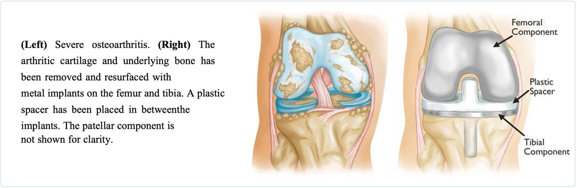Severe Osteoarthritis anatomy