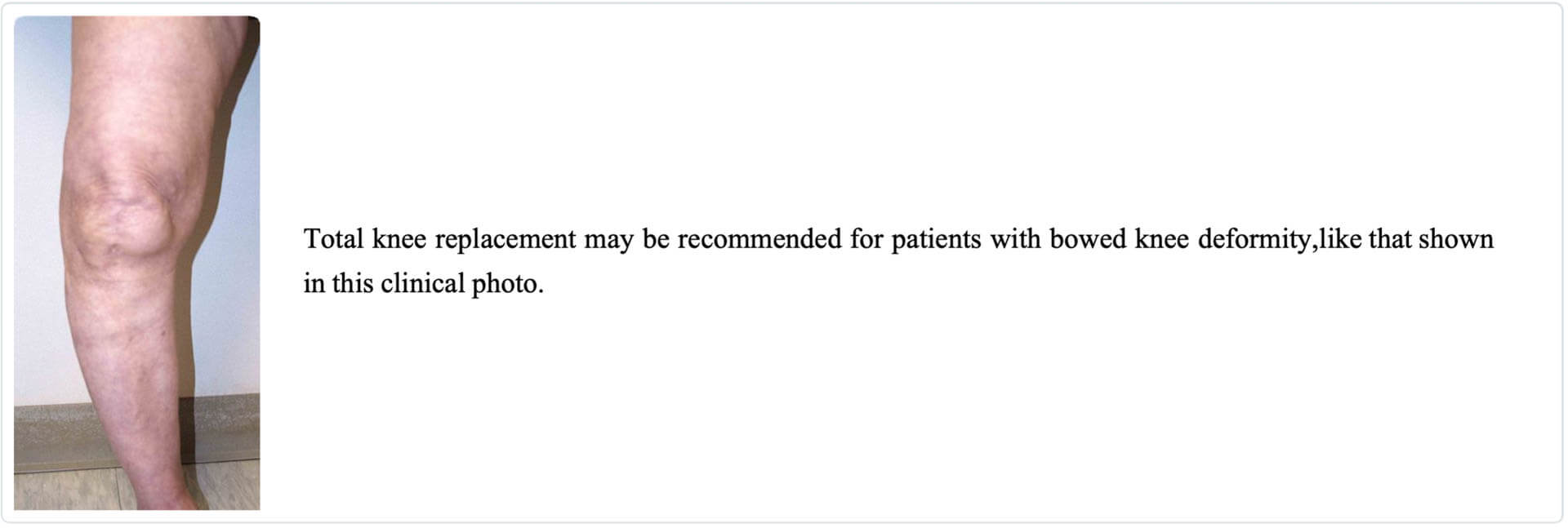 Bowed knee deformity