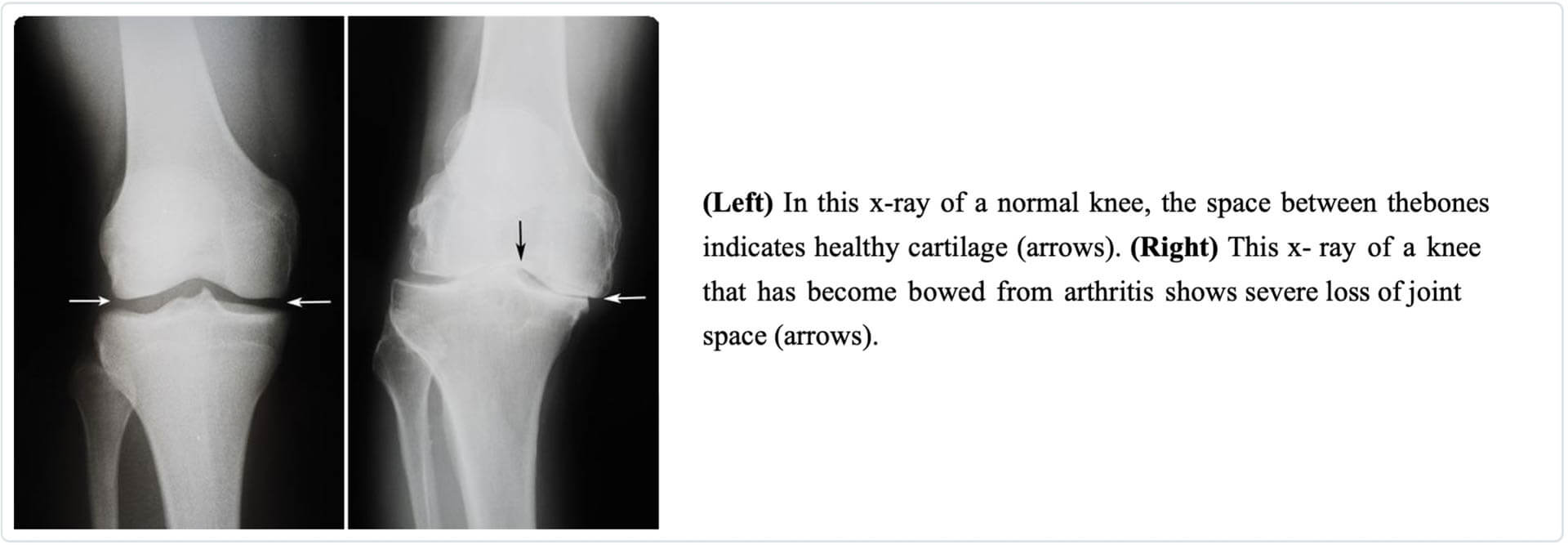 x-ray arthritis bowed