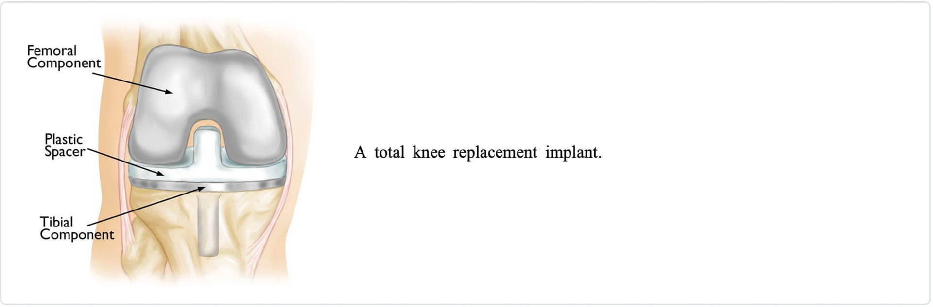 Solved] The contact between femoral and tibia components in knee joint