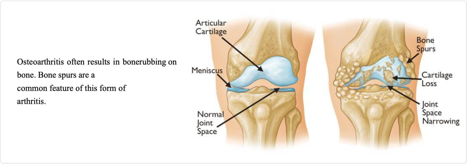 Osteoarthritis anatomy