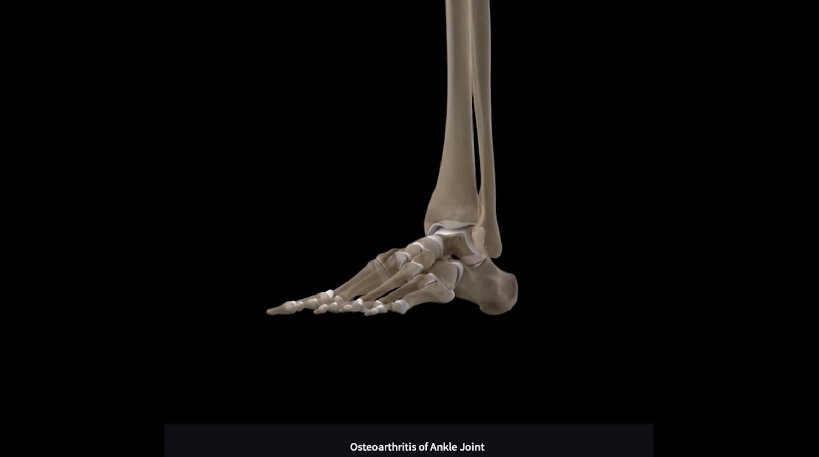 Total Ankle Replacement DIAGNOSIS