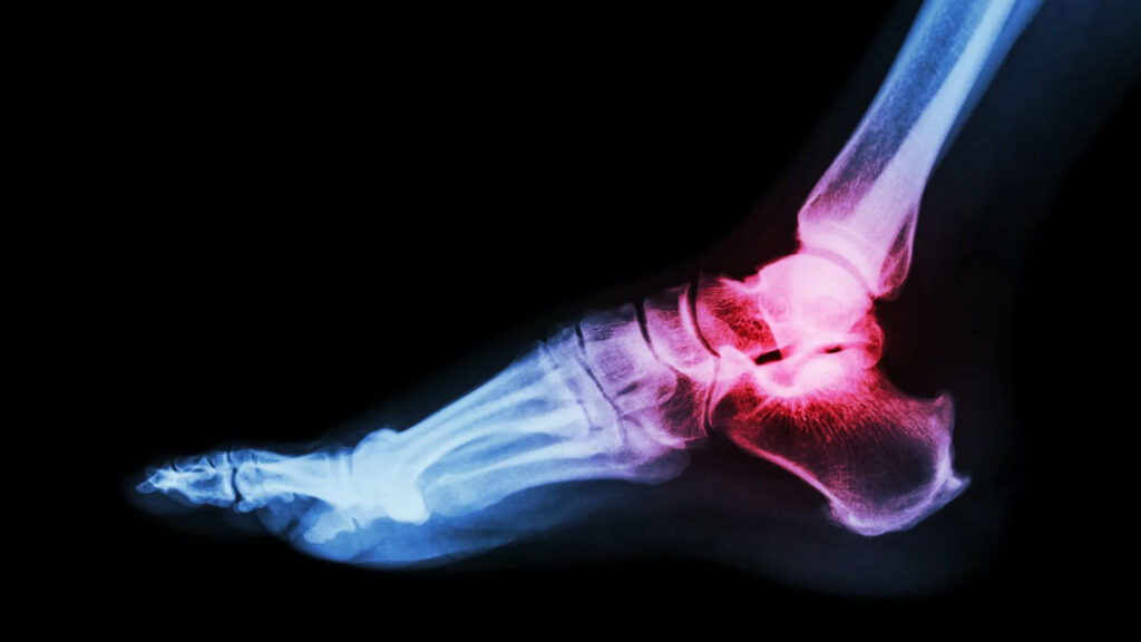 ankle arthritis