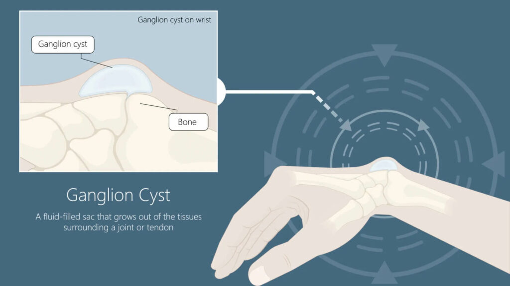 ganglion cyst