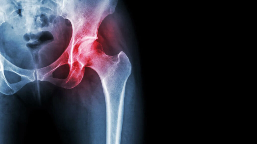 hip arthritis