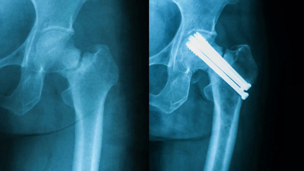 hip fracture