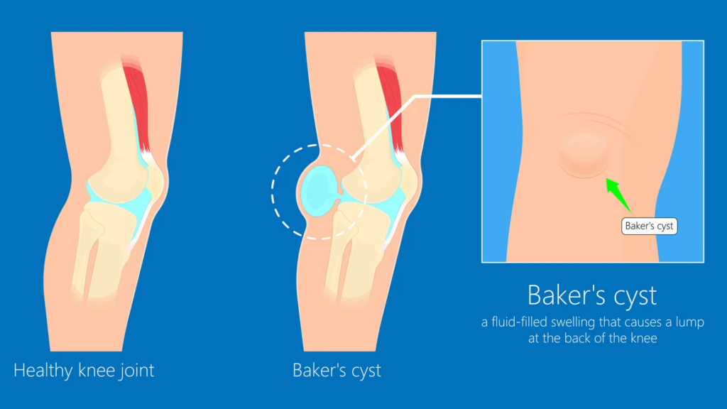 knee cyst