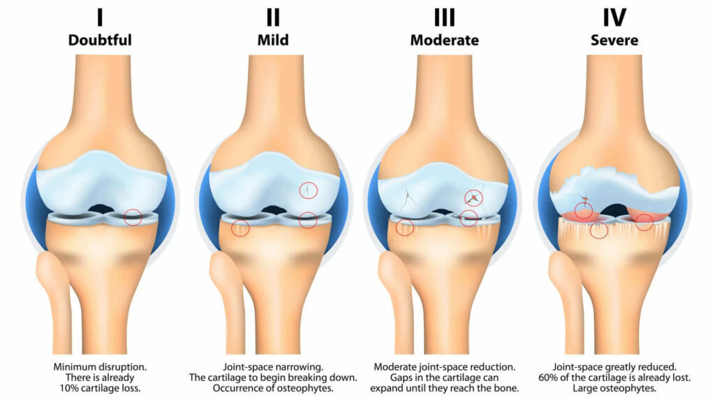 knee osteoarthritis