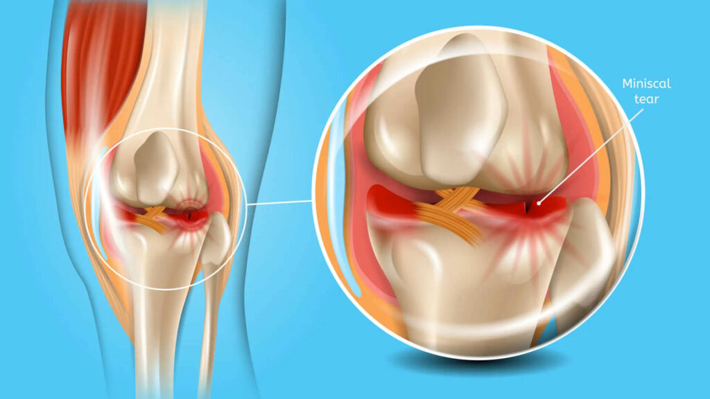 torn meniscus